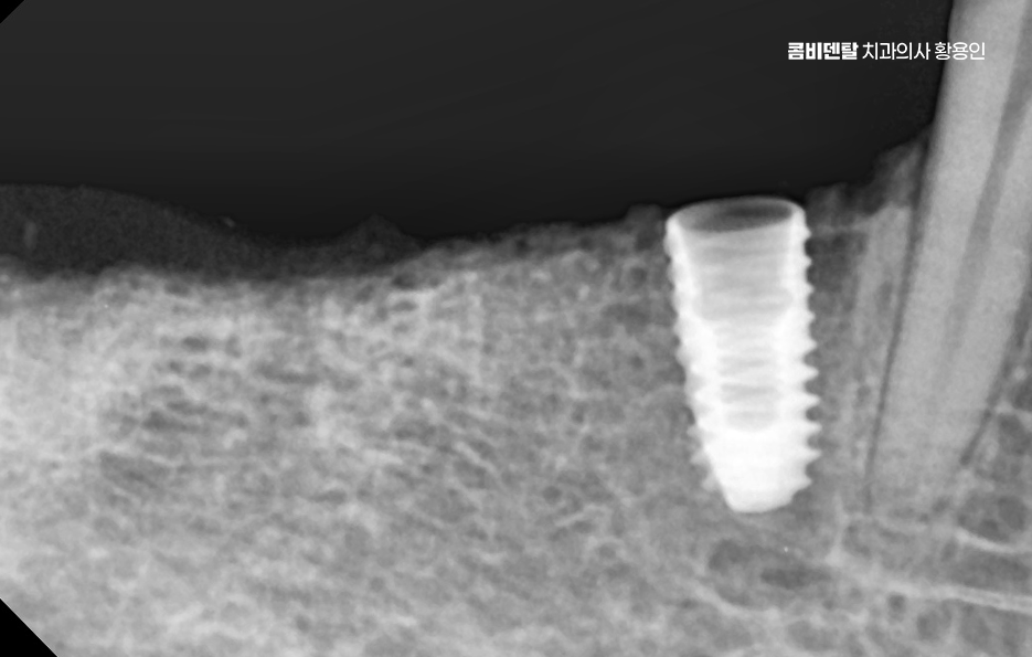 임플란트 뼈이식 안하면 어떤 문제가 있는거죠 관련 이미지 3