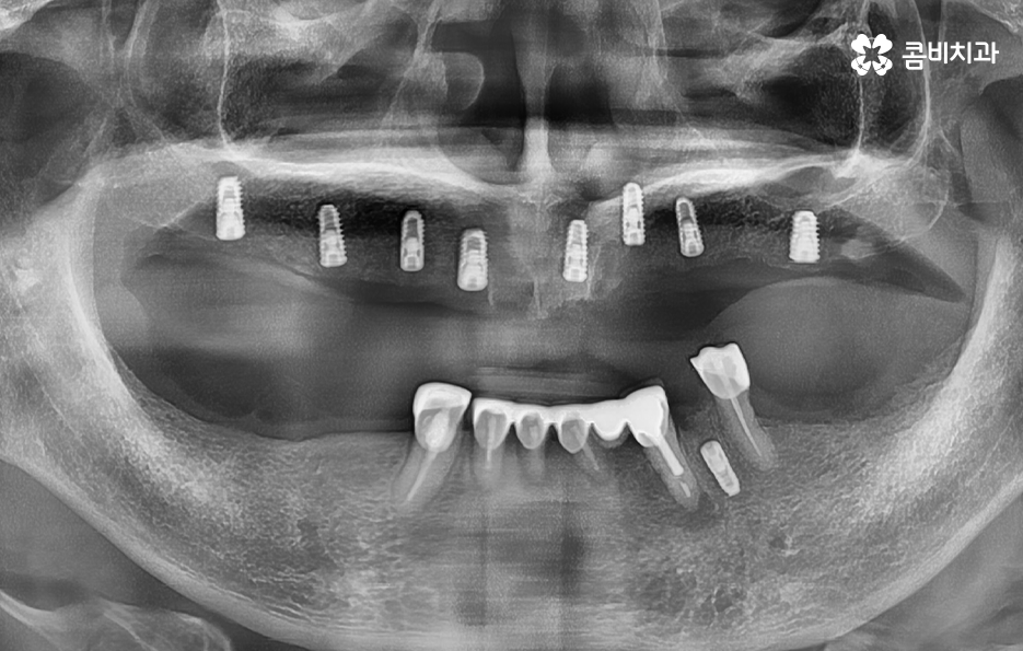 임플란트 나이 얼마나 영향을 줄까 관련 이미지 5