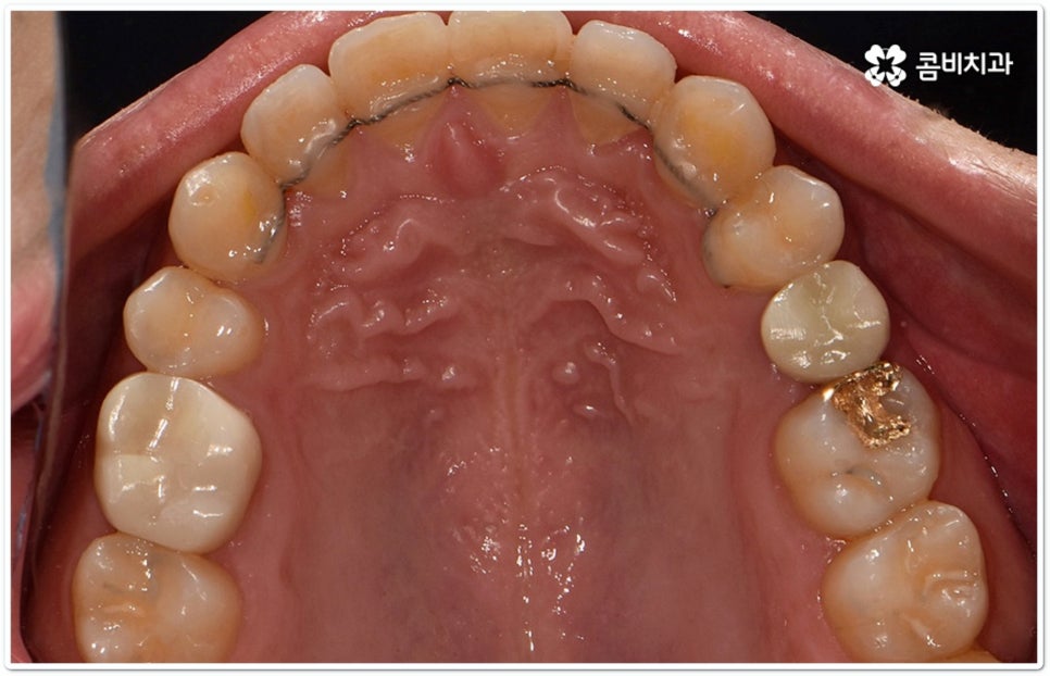 클리피씨교정 합리적인 초이스! 관련 이미지 12