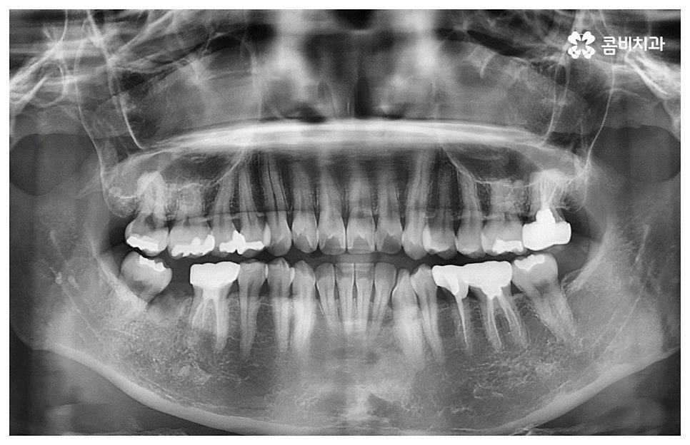 중년치아교정 원한다면 관련 이미지 2