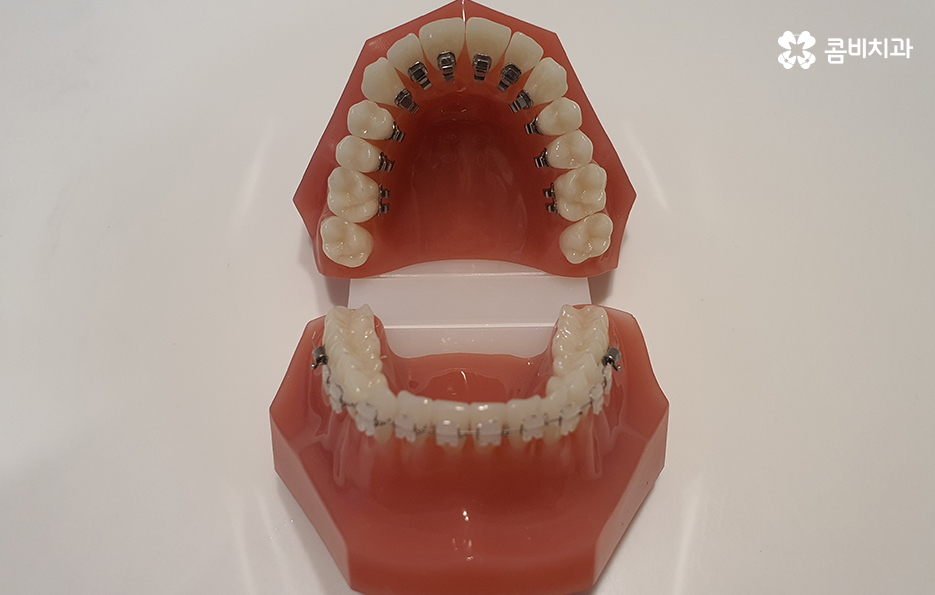 콤비교정 나에게 적합한지 판단하려면 관련 이미지 2