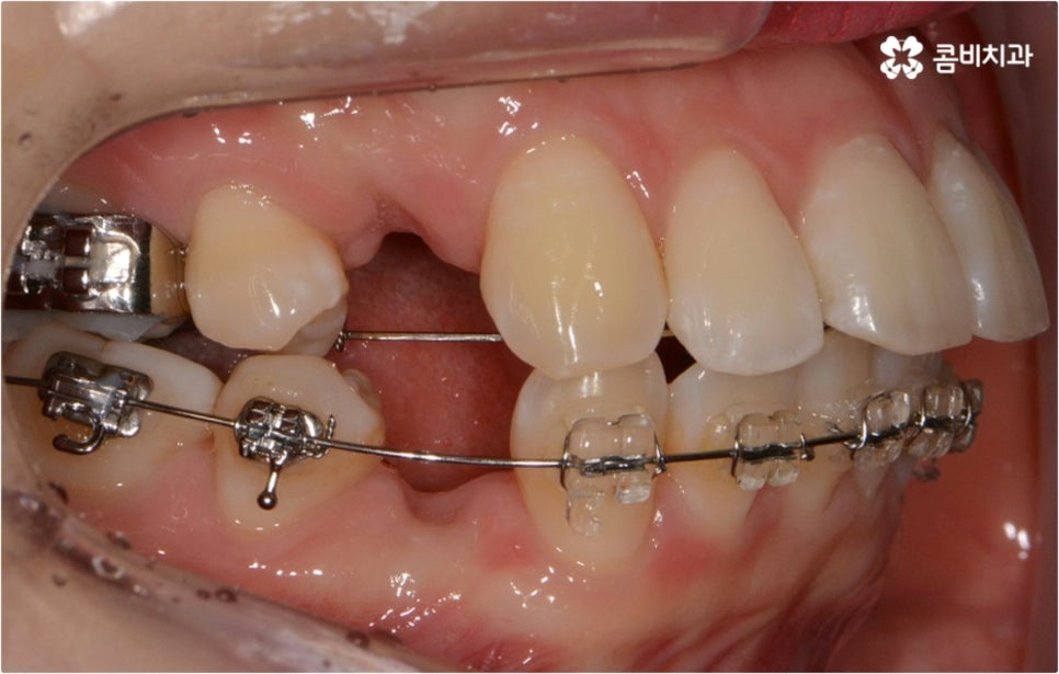 돌출입 치아교정 부모와 아이가 함께 알아봐요 관련 이미지 5