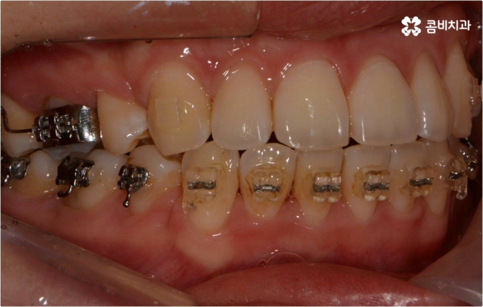 돌출입 치아교정 부모와 아이가 함께 알아봐요 관련 이미지 11