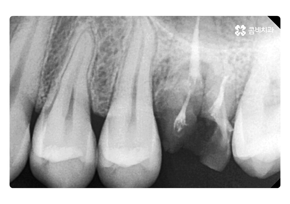 충치로 인한 치아 부러짐 결국 이렇게 될 수 있다 관련 이미지 5