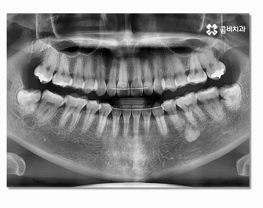 부분매복사랑니 언제 뽑아야 할까 관련 이미지 7