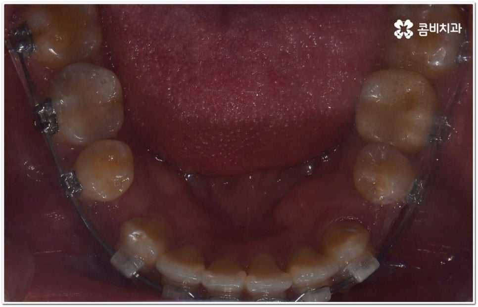 돌출입교정치과 알아보는 기준은 관련 이미지 13