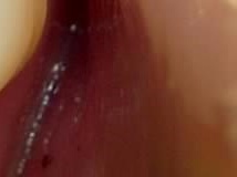 어금니 임플란트 수명 어느정도나 지속될까 관련 이미지 18