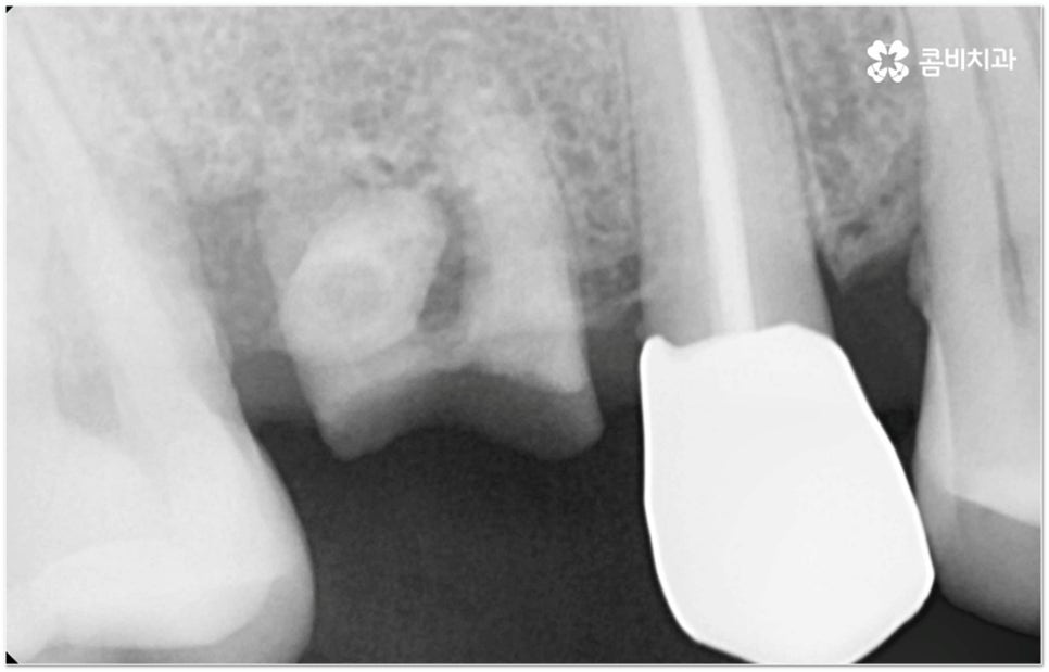 뼈이식임플란트 언제하나요? 관련 이미지 7