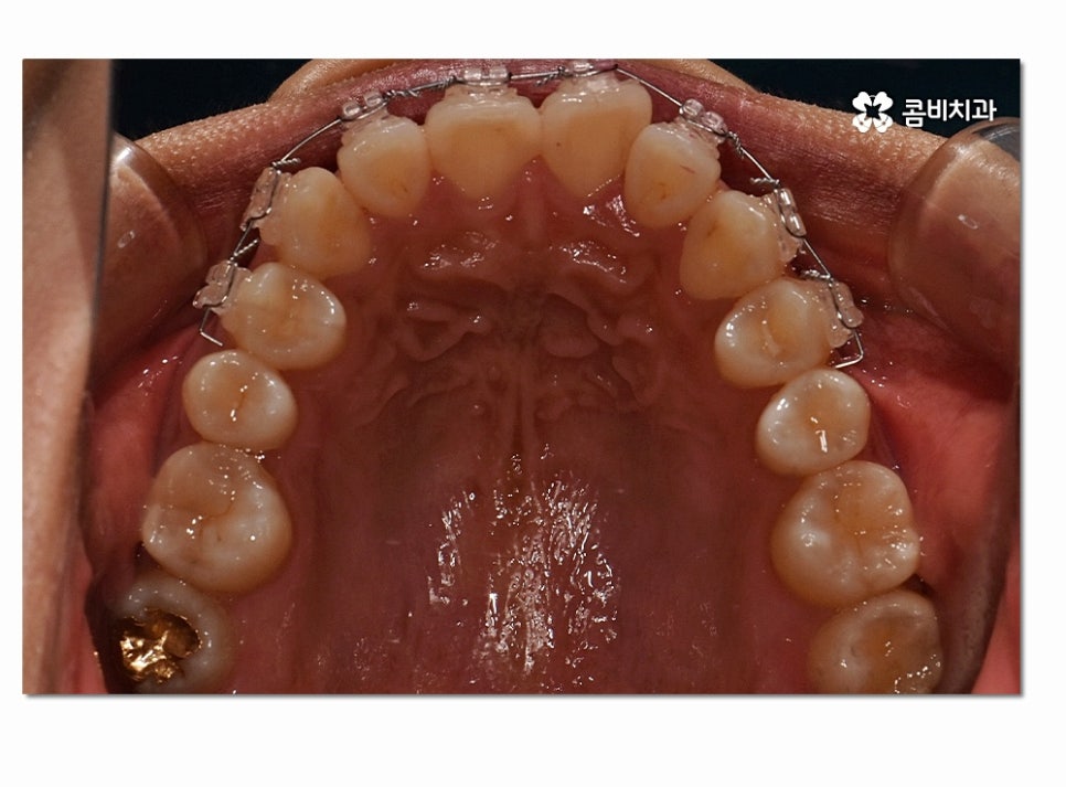 앞니 부분교정 오래 걸리지 않고 원하는 부위만 관련 이미지 9