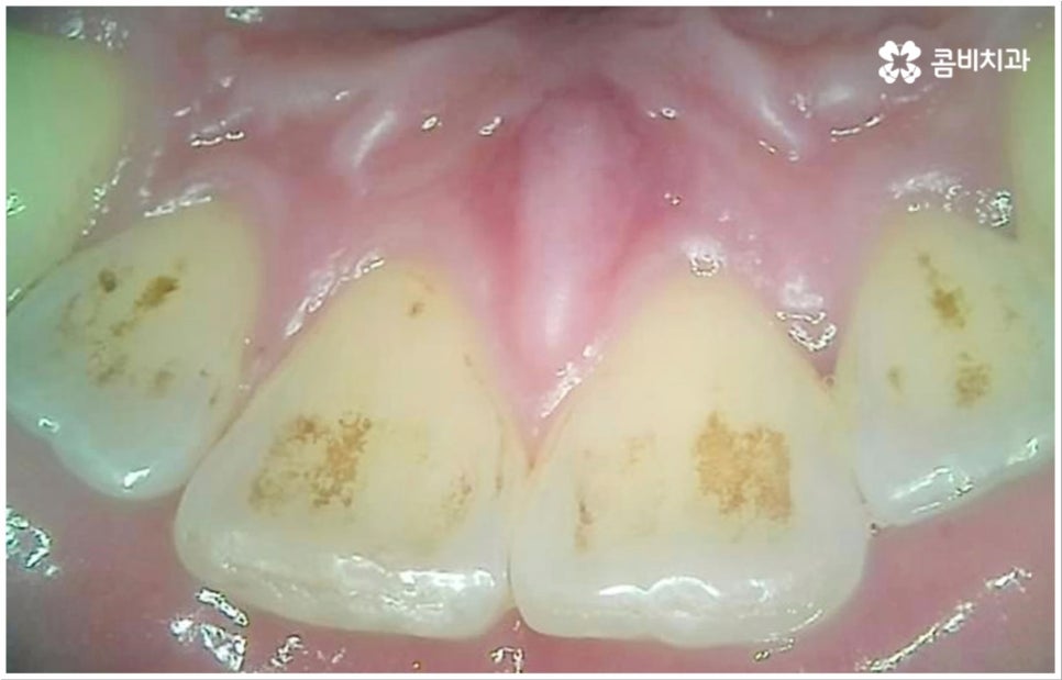 충치 통증 참지마세요 관련 이미지 1