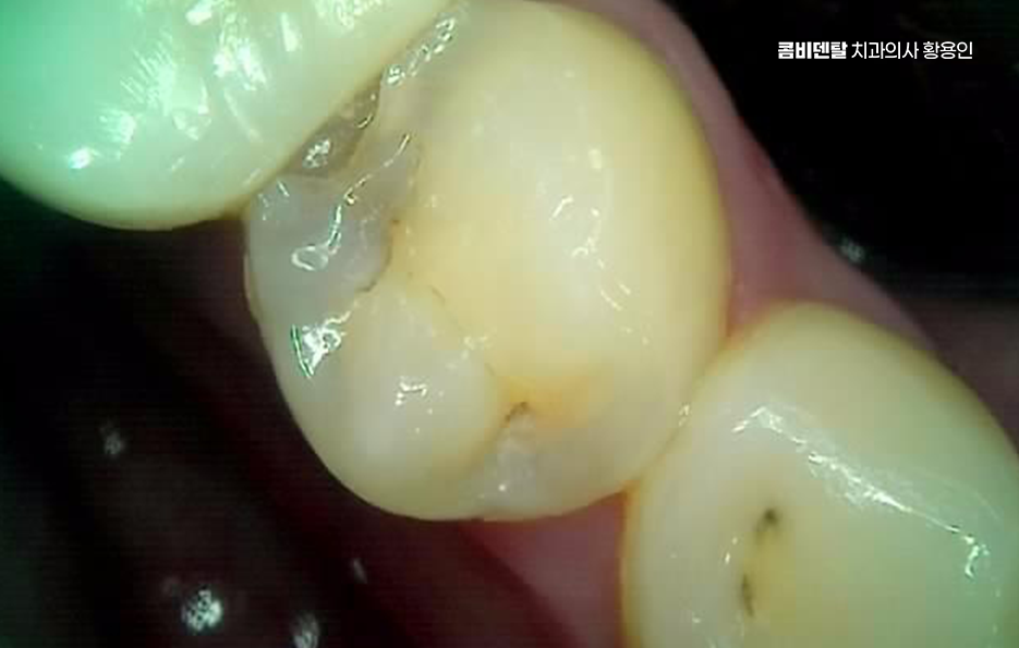 어금니 충치 단계 미리 알아차리려면 관련 이미지 7