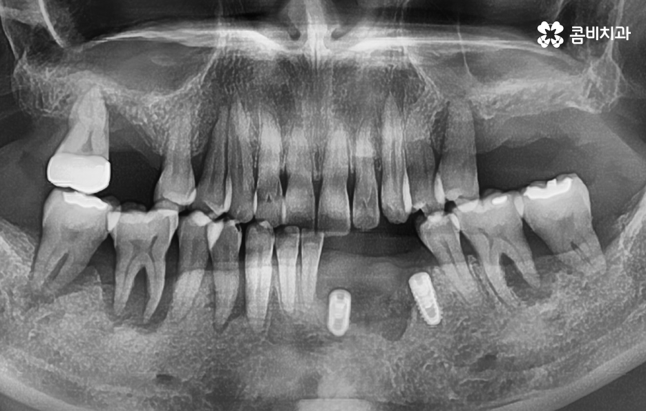 치아 옆면 충치 이렇게 무섭습니다 관련 이미지 6