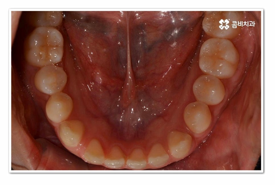 앞니 벌어짐 똑똑하게 해결하려면 관련 이미지 5