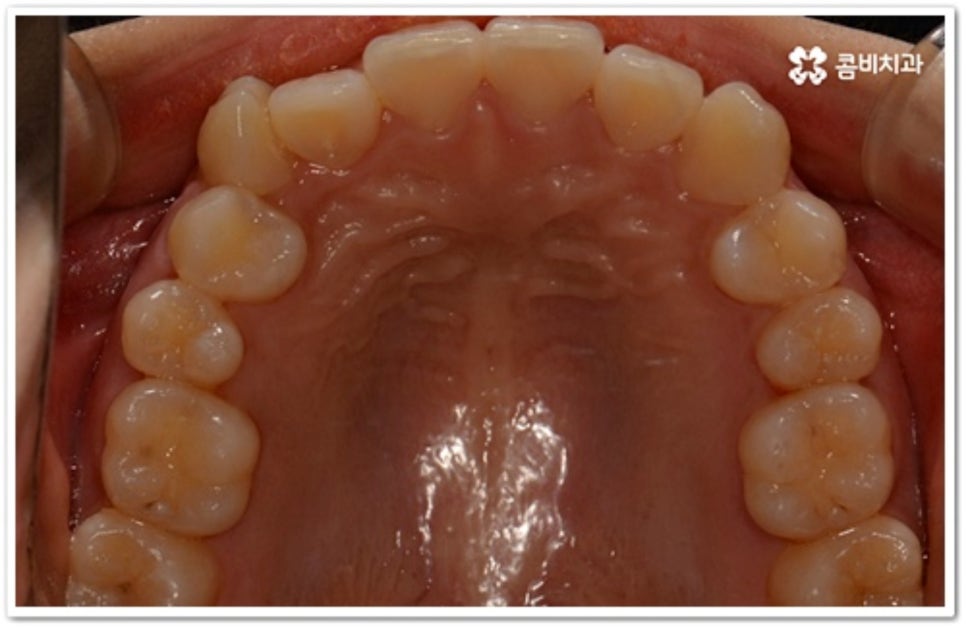 덧니 발치 언제 하나요? 관련 이미지 4