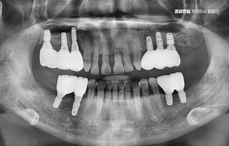 어금니 발치후 임플란트 안하면 어떻게 변하는걸까 관련 이미지 13