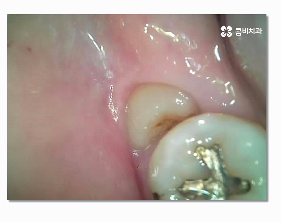 부분매복사랑니 언제 뽑아야 할까 관련 이미지 2