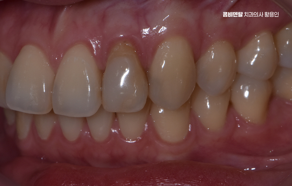 앞니 틀어짐 부분교정 얼마나 걸릴까 관련 이미지 4