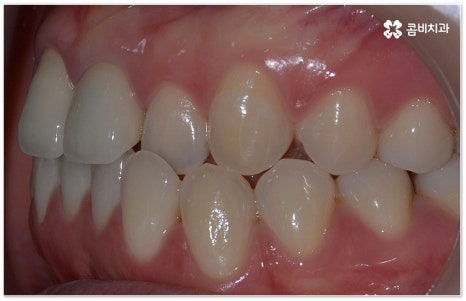 치아교정장치 어떻게 고르나요 관련 이미지 5