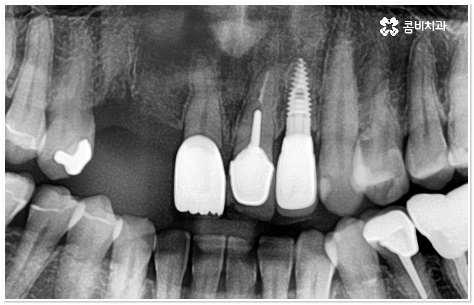 앞니임플란트 체크할 사항들은? 관련 이미지 1