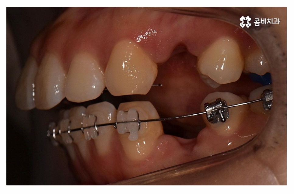 돌출입치아교정 적극적으로 해결하려면 관련 이미지 8