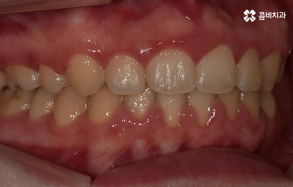 치아 벌어짐 교정으로 앞니 돌출까지 해결하기 관련 이미지 9
