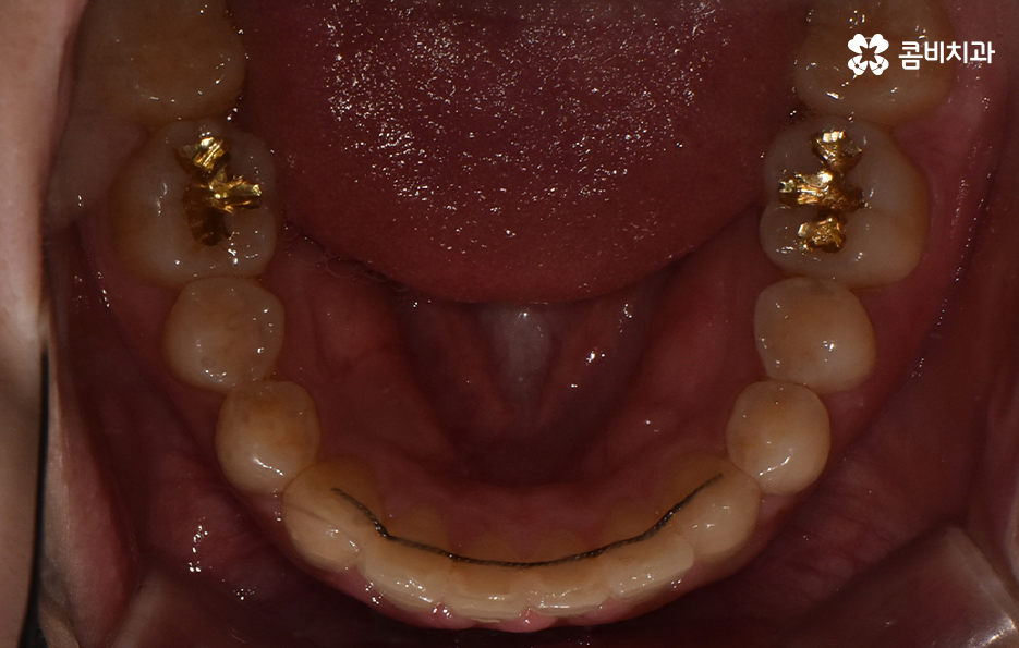 덧니 비발치 교정 자연스럽게 가능한 경우도 있어요 관련 이미지 11