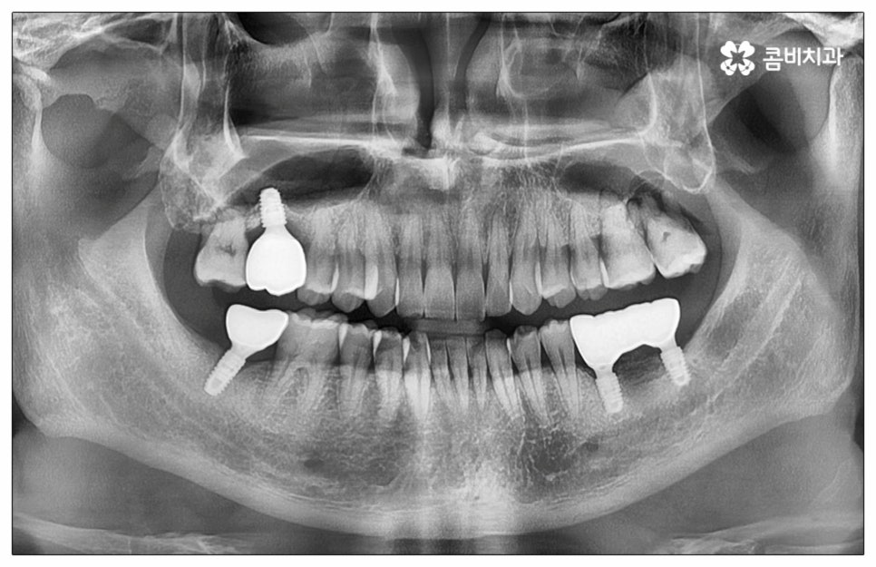 건강보험임플란트 혜택받아 보세요 관련 이미지 13