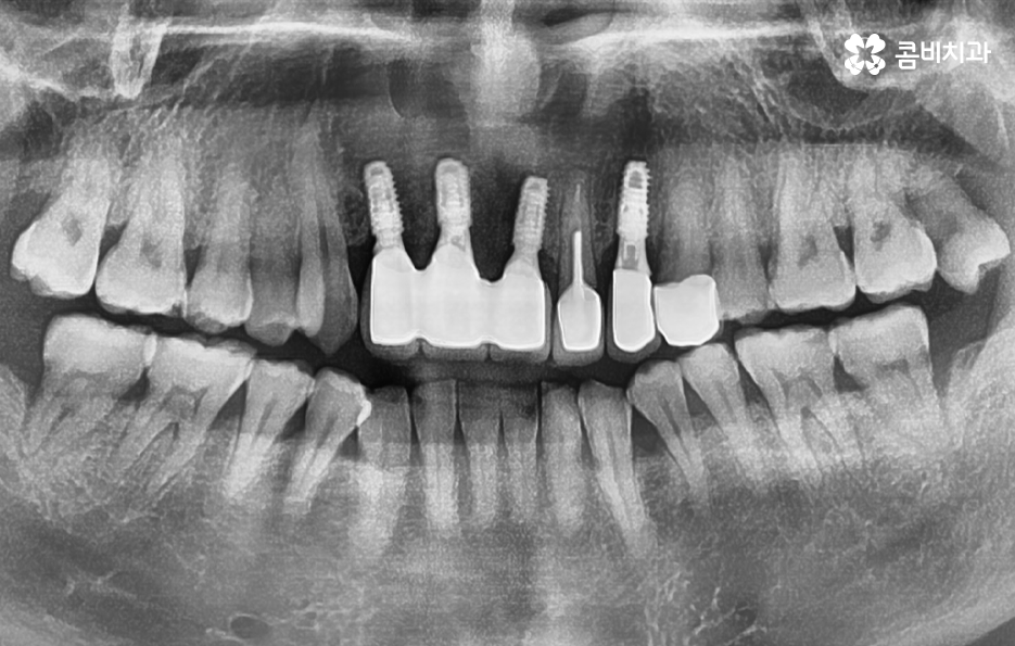 앞이빨 임플란트 과정 주의해야할 포인트는 관련 이미지 7