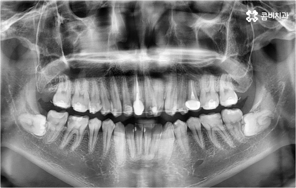 덧니교정 하고싶다면 관련 이미지 7