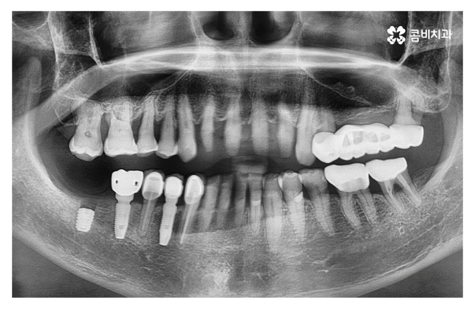 임플란트 기간 케이스에 따라 달라진다면 관련 이미지 2