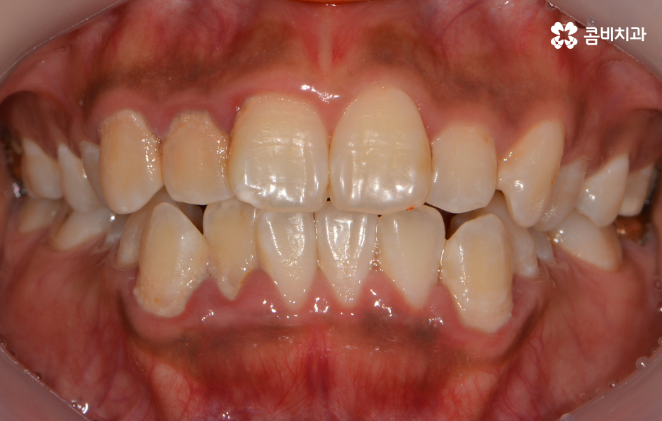 클리피씨교정 알아볼 때 꼭 신경 써야 하는 점은! 관련 이미지 1