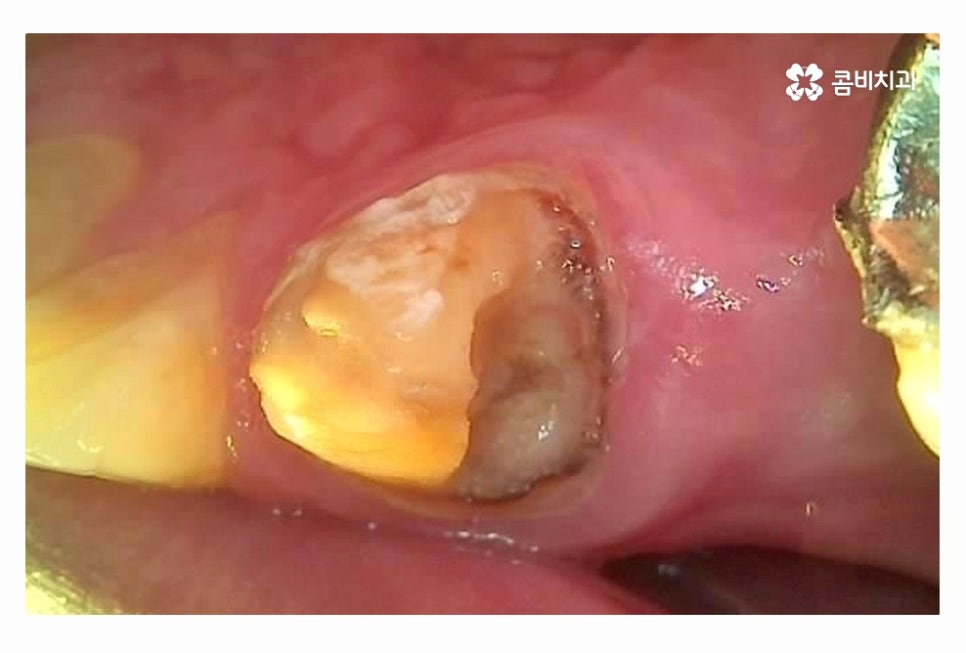 20대임플란트 갈수록 늘어나는 이유는 관련 이미지 2