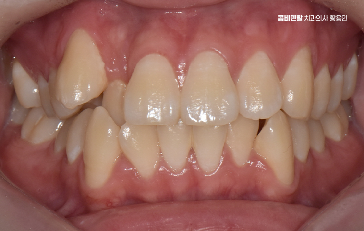 송곳니 덧니 발치 이럴때 해당되네요