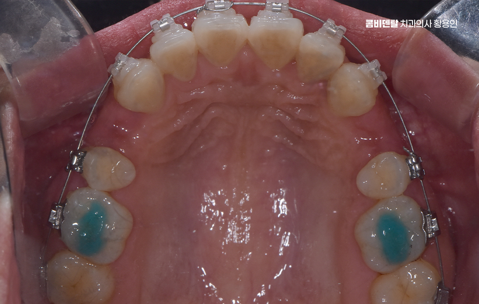 돌출입 팔자주름 교정 얼마나 바뀔까요 관련 이미지 10