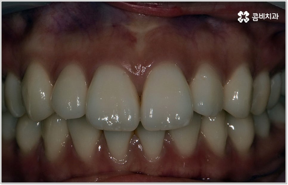 돌출입치아교정 언제가 적기인가요? 관련 이미지 9