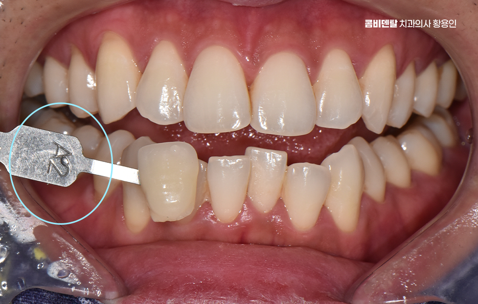 치과 치아미백 효과 어떤식으로 나타날까 관련 이미지 3