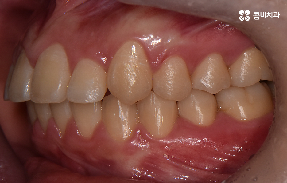 덧니 비발치 교정 자연스럽게 가능한 경우도 있어요 관련 이미지 9