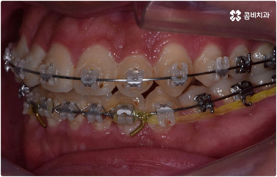 부정교합 3급 고치는 방법은 관련 이미지 11