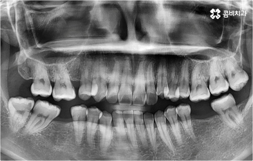 치아설측교정 보이지않아 좋아요 관련 이미지 1