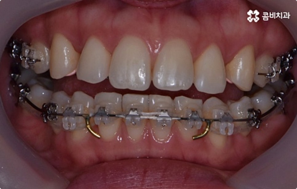 직장인치아교정 어떻게 시작하나요? 관련 이미지 8