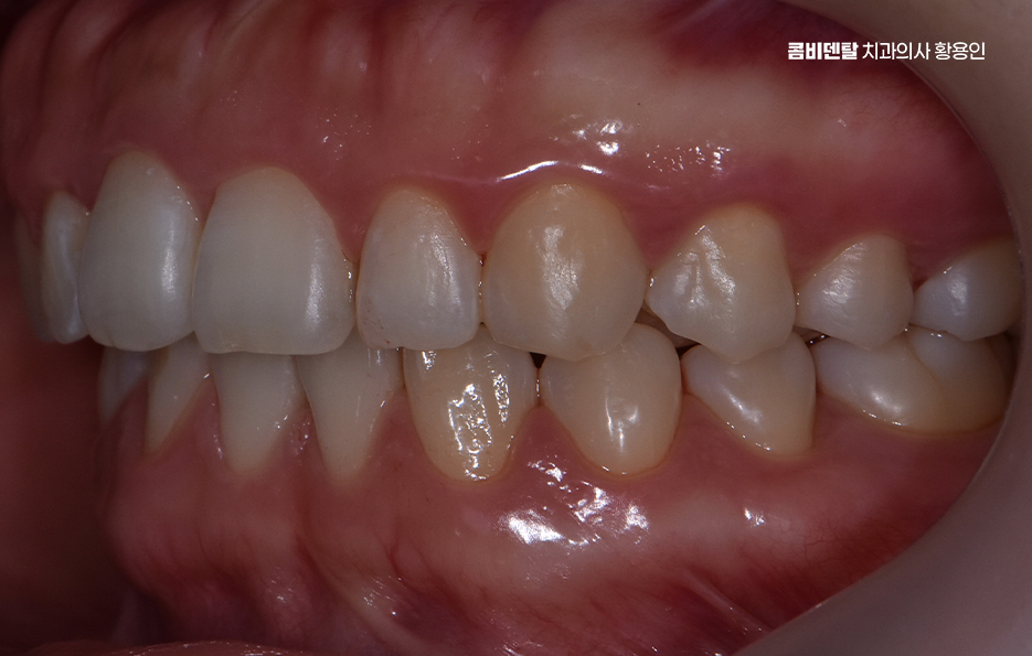 치아교정 통증 줄이는 방법 어떻게 가능할까요 관련 이미지 11