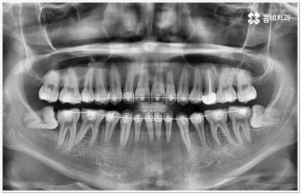 아래사랑니발치 망설이고 있다면 관련 이미지 9