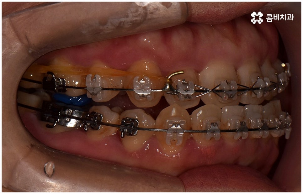 반대교합교정 늦지 않았어요 관련 이미지 10
