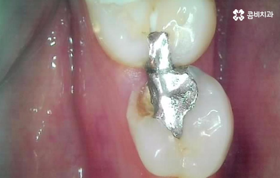 어금니 충치 깨짐 판단기준부터 세워보세요 관련 이미지 8