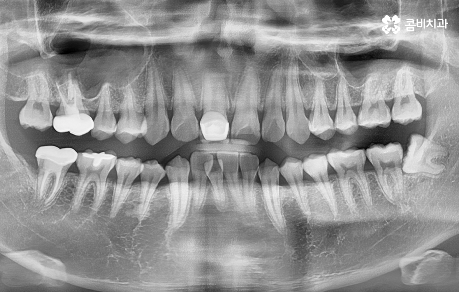 아랫니교정 이렇게만 파악하시면 됩니다 관련 이미지 6