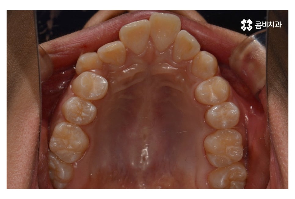 중학생치아교정 세심하게 체크하려면 관련 이미지 3