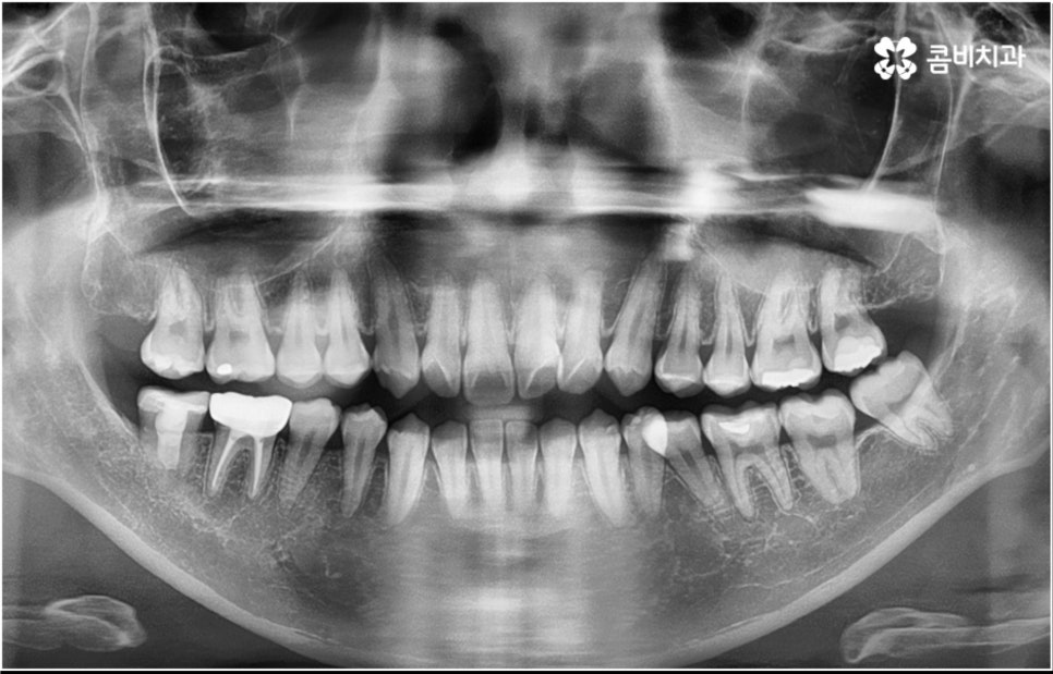 성인 치아교정 기간 걱정이 앞서나요 관련 이미지 2