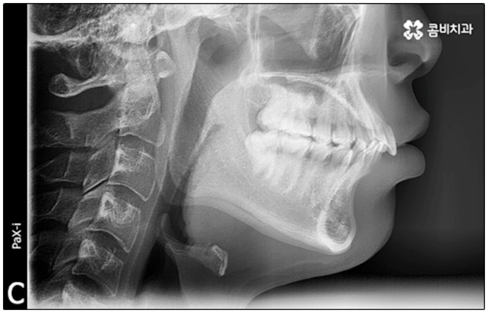 클리피씨교정 알아봐야 할것들 관련 이미지 1