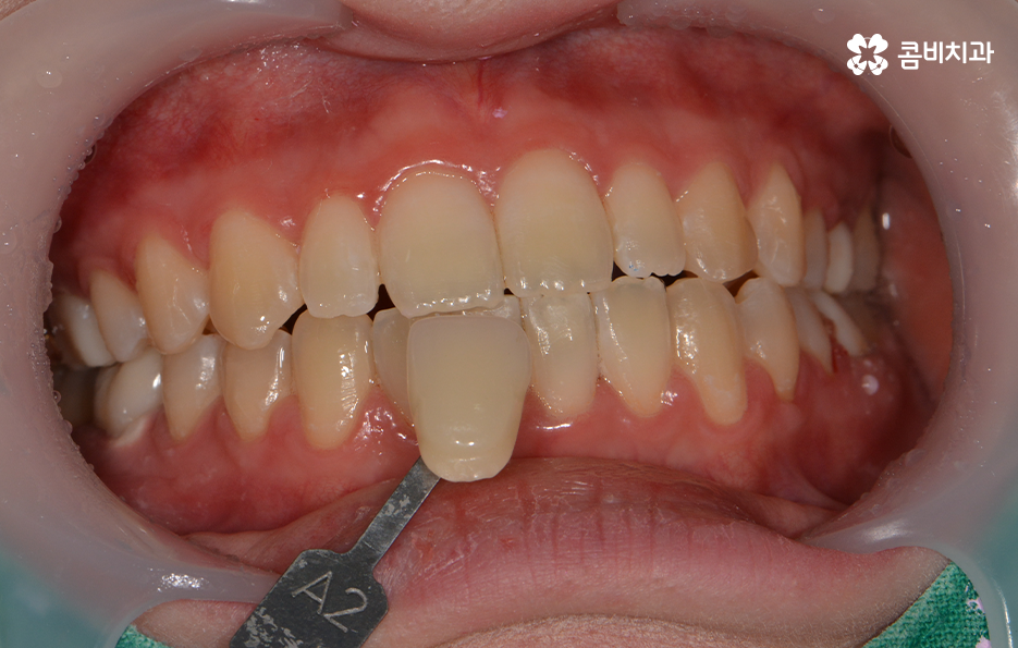 치과치아미백 어떻게 다른지 설명해드려요 관련 이미지 3