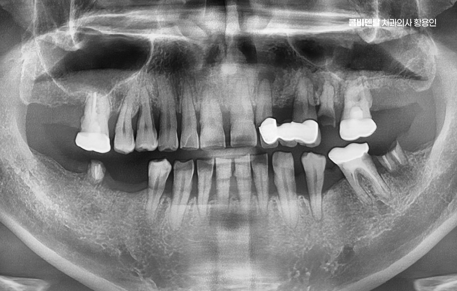 치아 발치 후 임플란트 언제부터 준비할까 관련 이미지 1